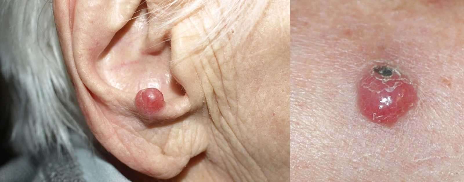 Merkel Cell Skin Cancer: Symptoms and Causes